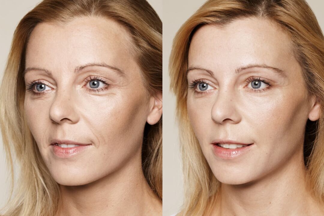 Experiência de uso antes e depois do creme intenskin da Valeria