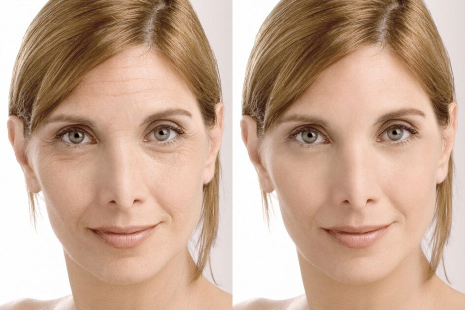 Experiência de uso antes e depois do creme intenskin de Milana